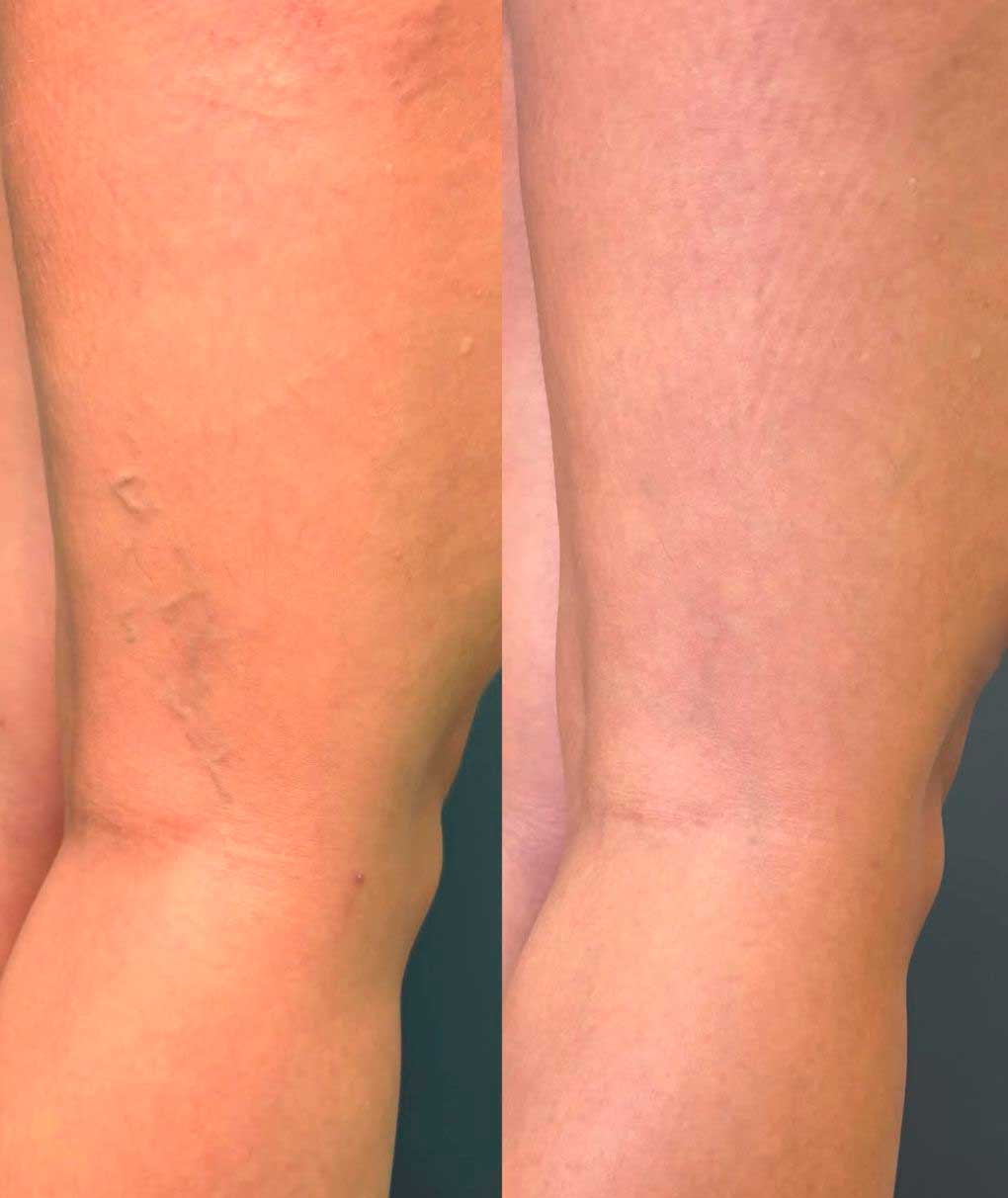 Resultado de tratamento de varizes — antes e depois