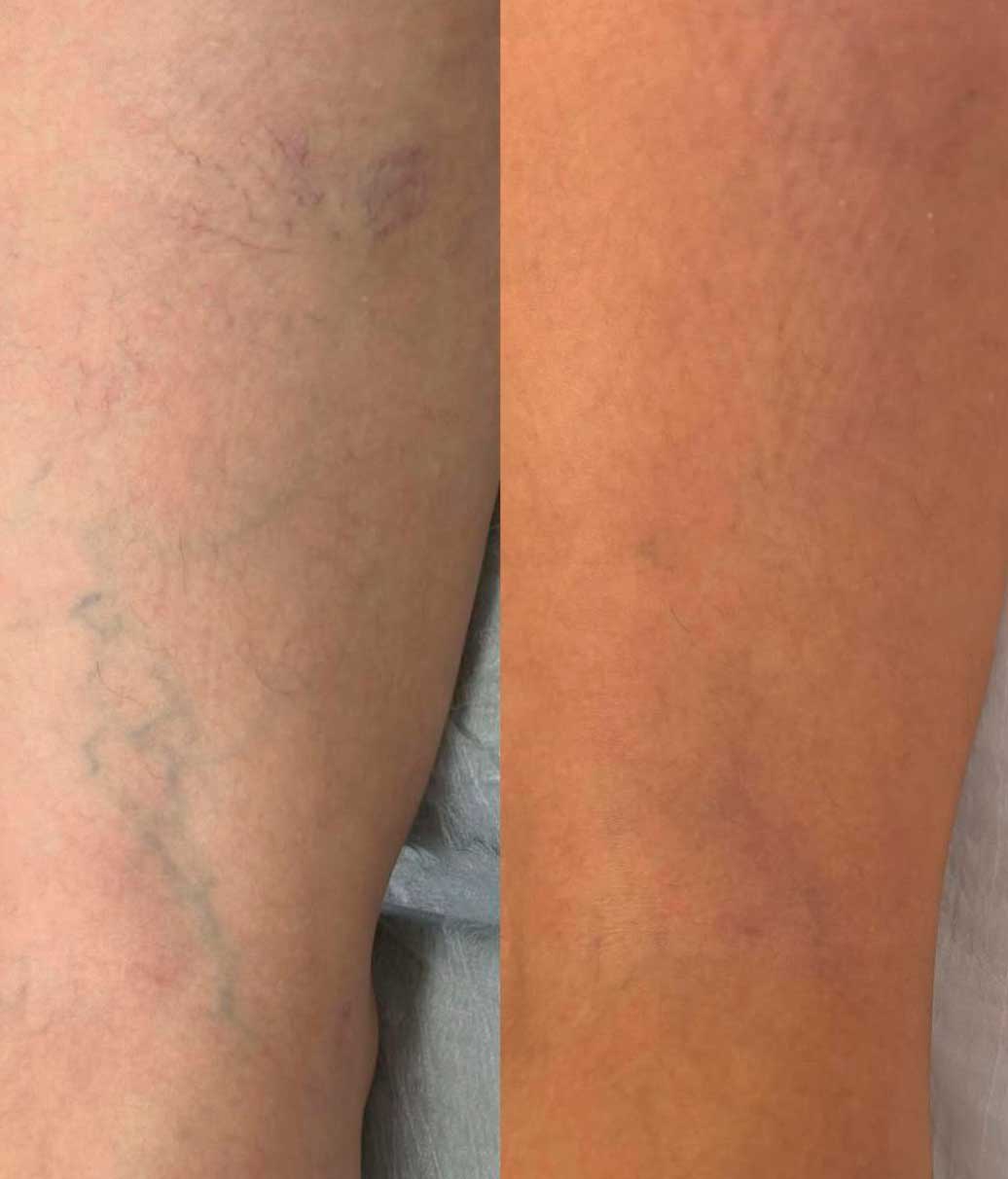 Resultado de tratamento de vasinhos — antes e depois