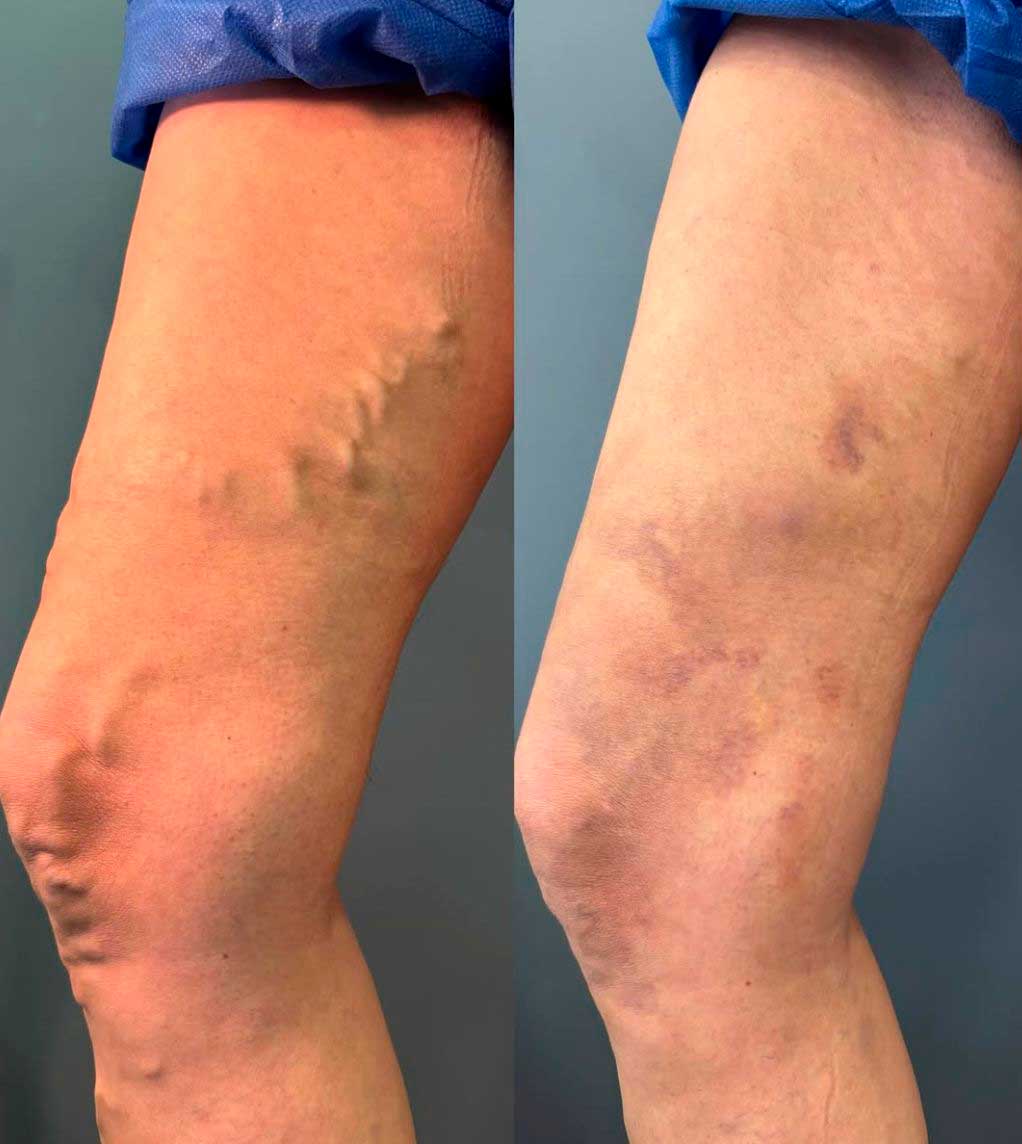 Resultado de tratamento de varizes na perna — antes e depois