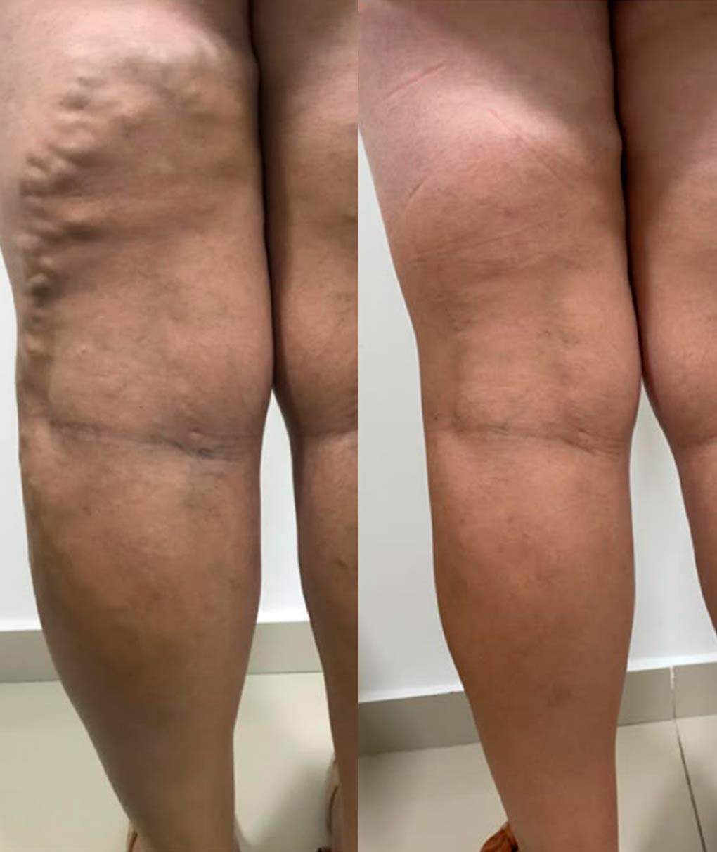 Resultado de tratamento de varizes — antes e depois