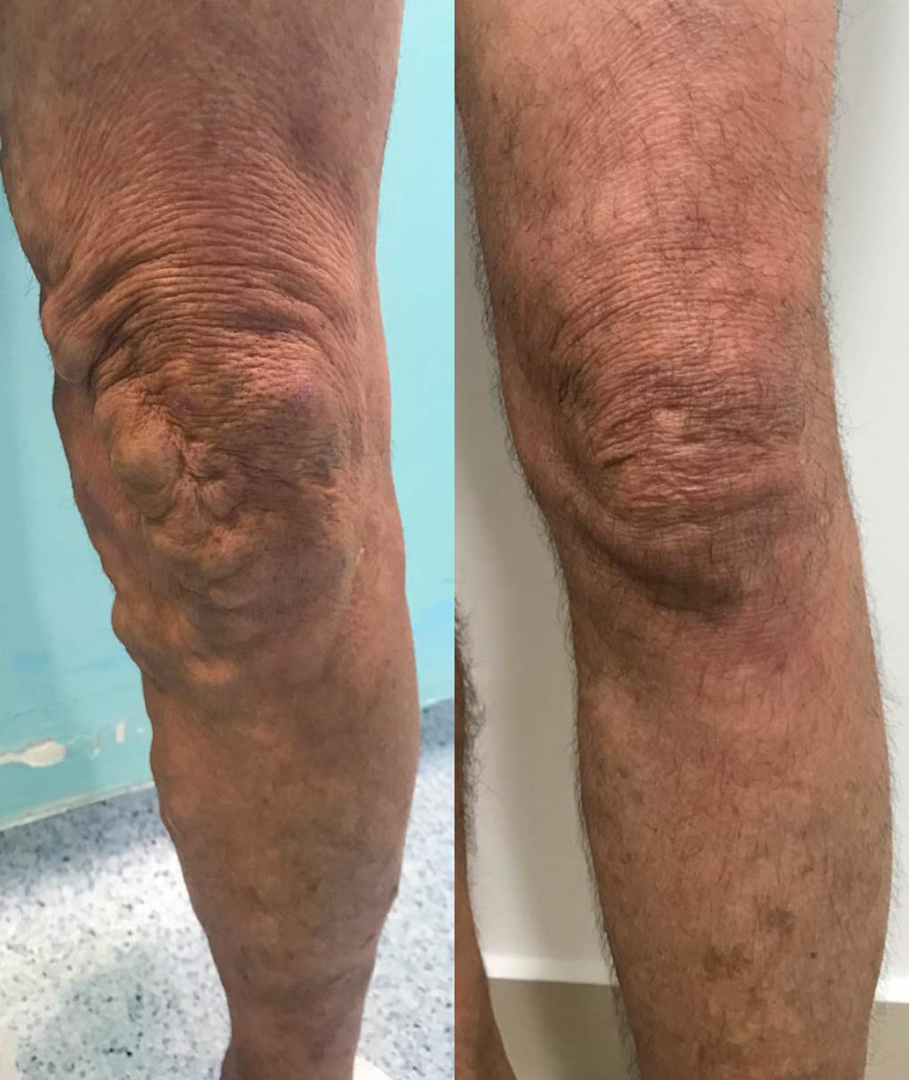 Resultado de tratamento de varizes — antes e depois