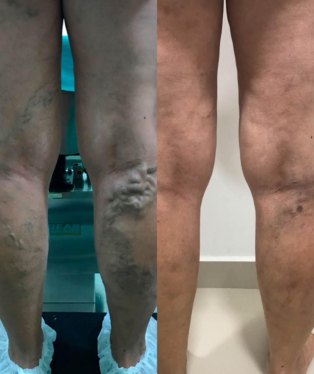 Resultado de tratamento de varizes — antes e depois